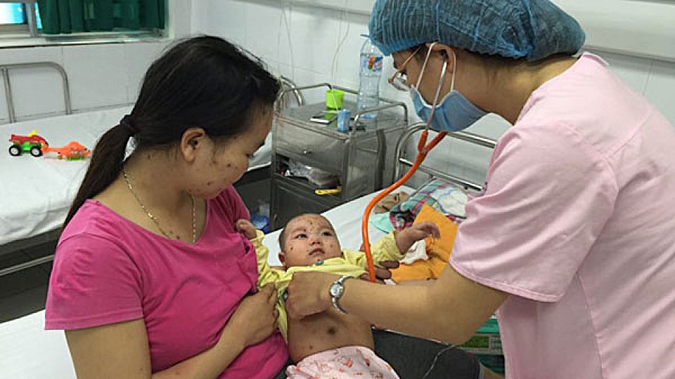   Tăng cường Nh88 Nha cai phòng, chống bệnh sởi trên địa bàn tỉnh